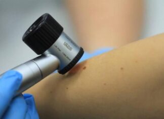 Пензенцам рассказали про опасные родинки