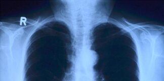 Что надо знать о туберкулезе