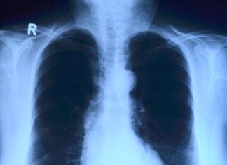 Что надо знать о туберкулезе