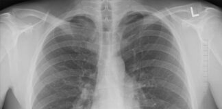 Откуда растут ноги у пневмонии