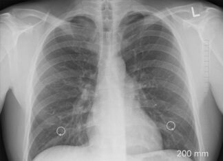 Откуда растут ноги у пневмонии