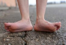 Плоскостопие у взрослых. Что делать?