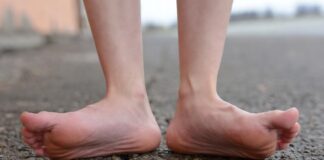 Плоскостопие у взрослых. Что делать?