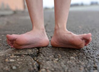 Плоскостопие у взрослых. Что делать?