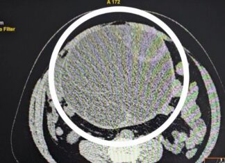 У молодой жительницы Заречного удалили гигантскую опухоль